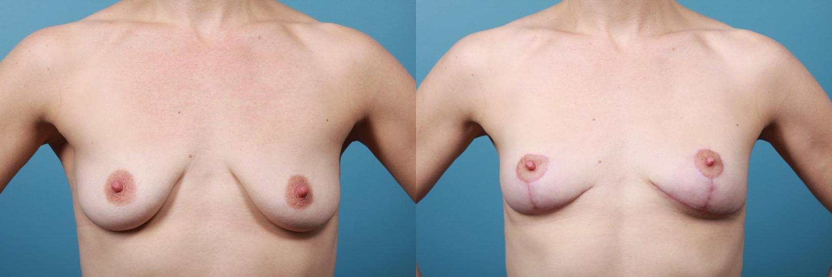 Before & After Breast Lift Case 235 View #1 View in Portland, OR