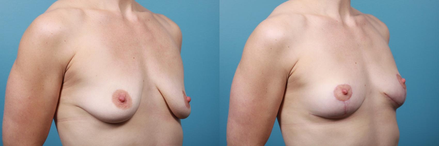 Before & After Breast Lift Case 235 View #3 View in Portland, OR