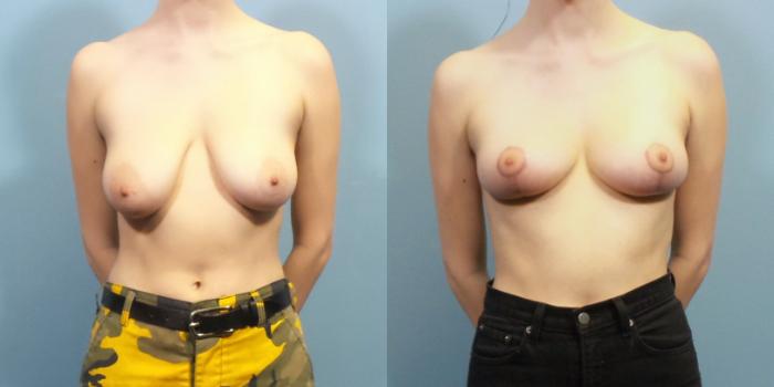 Before & After Breast Reduction Case 262 View #1 View in Portland, OR