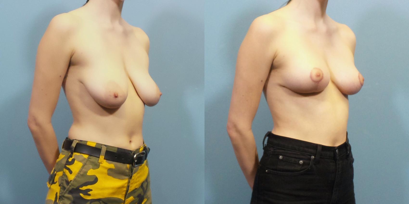Before & After Breast Lift Case 262 View #2 View in Portland, OR