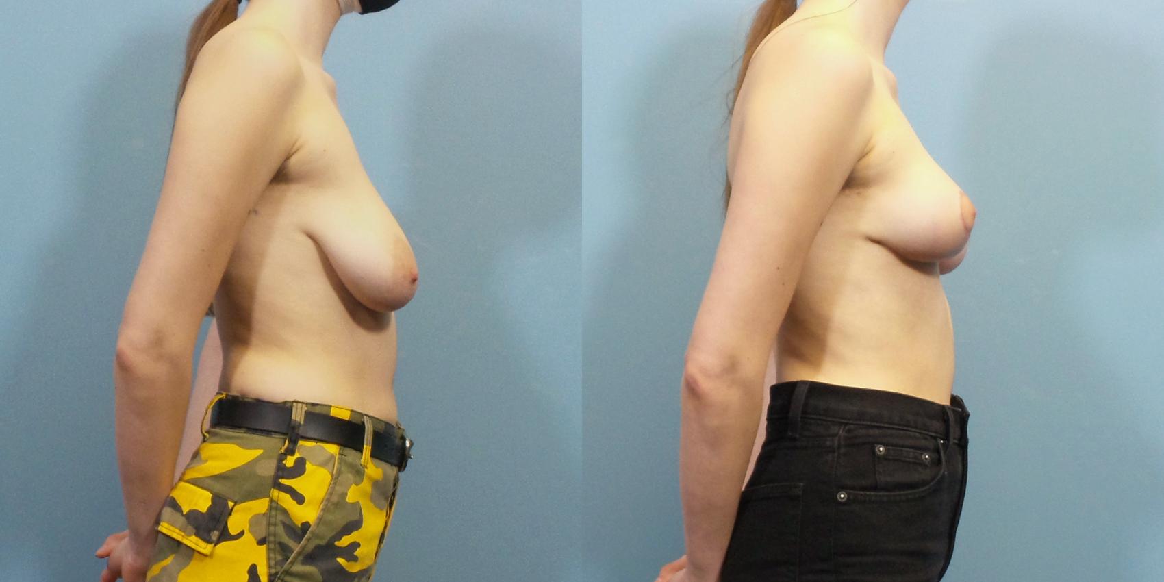 Before & After Breast Lift Case 262 View #3 View in Portland, OR