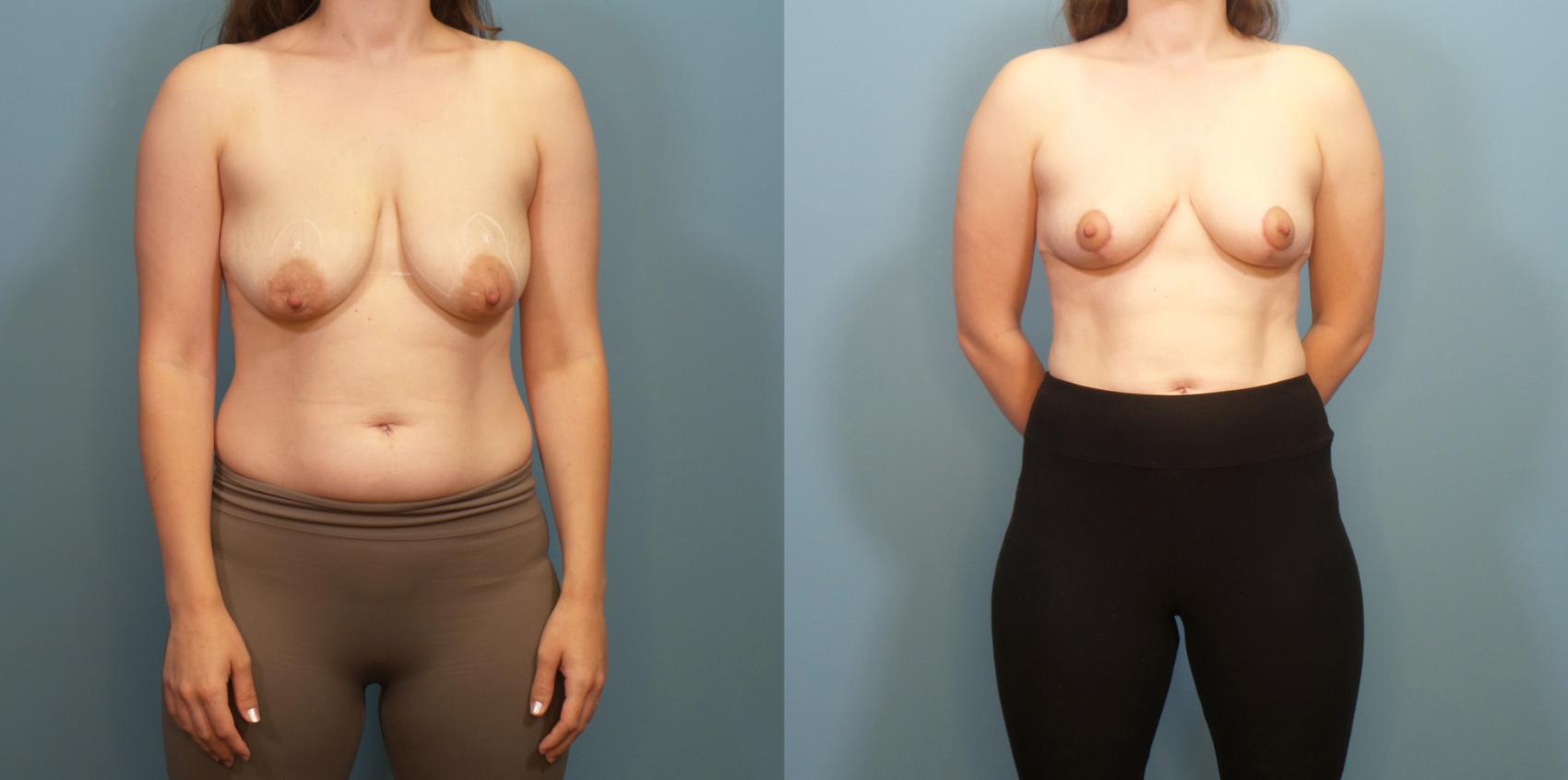 Before & After Breast Lift Case 282 Front View in Portland, OR