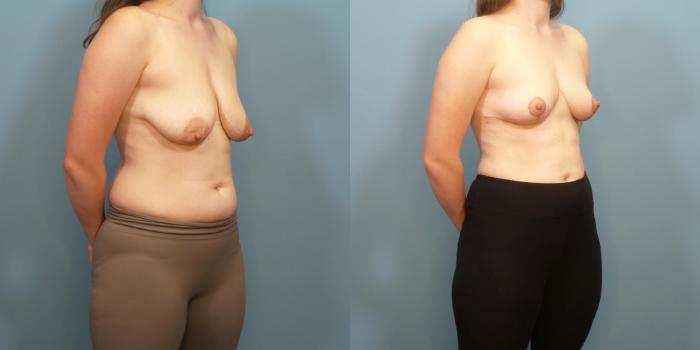 Before & After Breast Lift Case 282 Right Oblique View in Portland, OR