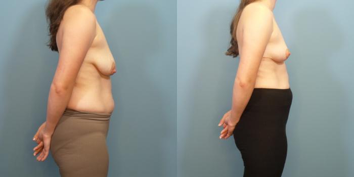 Before & After Breast Reduction Case 282 Right Side View in Portland, OR
