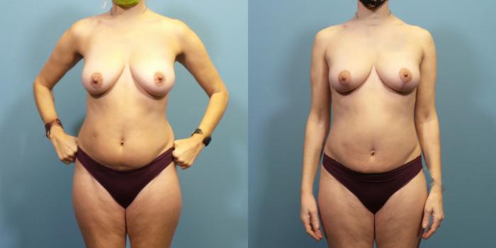 Before & After Breast Lift Case 285 Front View in Portland, OR