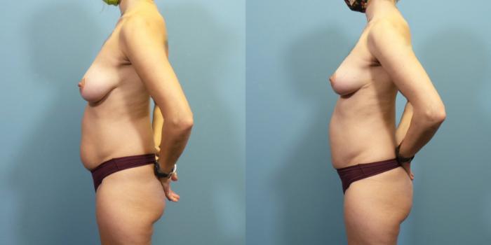 Before & After Breast Lift Case 285 Left Side View in Portland, OR