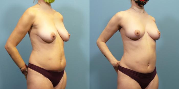 Before & After Breast Lift Case 285 Right Oblique View in Portland, OR