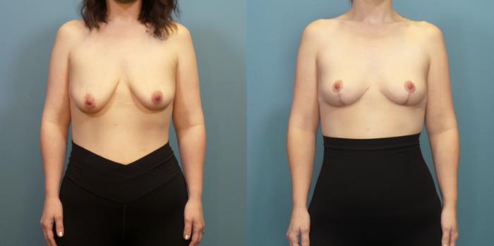 Before & After Breast Lift Case 286 Front (A) View in Portland, OR