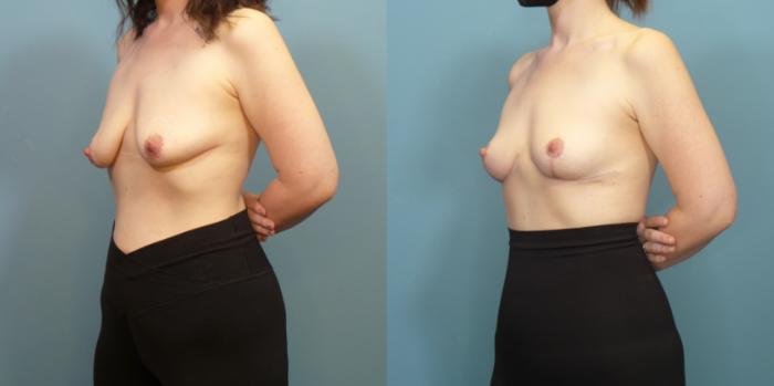 Before & After Breast Lift Case 286 Left Oblique View in Portland, OR