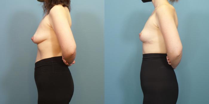 Before & After Breast Lift Case 286 Left Side View in Portland, OR