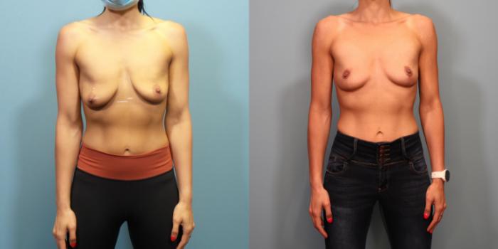 Before & After Breast Lift Case 296 Front View in Portland, OR