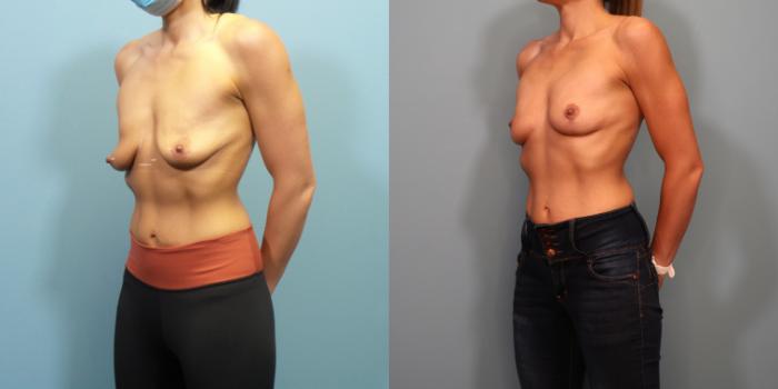 Before & After Breast Lift Case 296 Left Oblique View in Portland, OR
