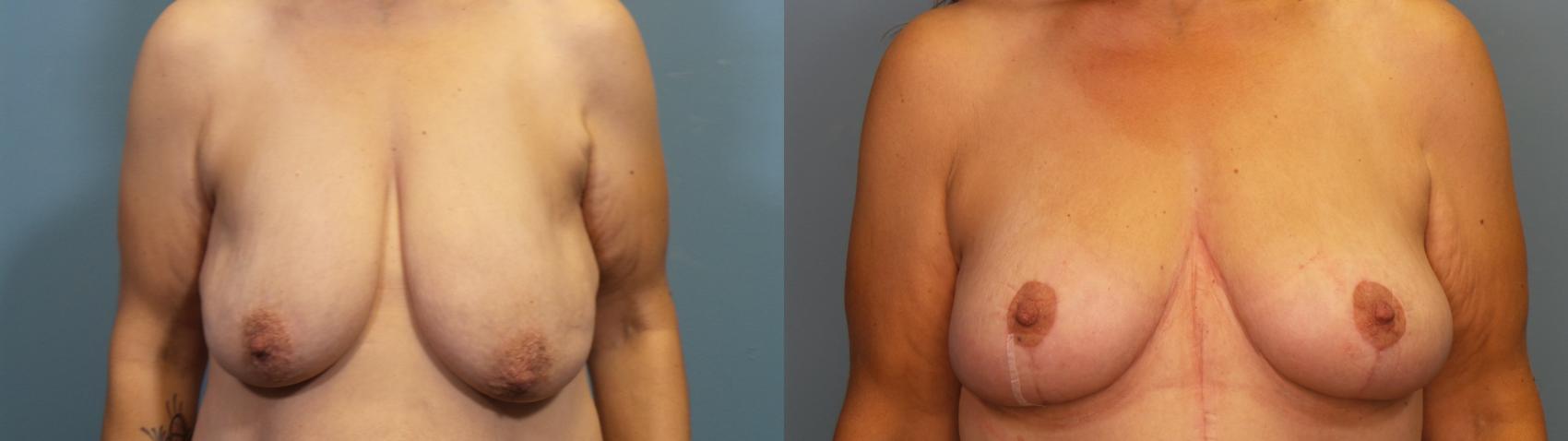 Before & After Breast Lift Case 332 Front View in Portland, OR