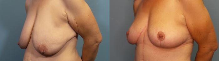 Before & After Breast Lift Case 332 Left Oblique View in Portland, OR