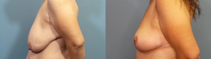 Before & After Breast Lift Case 332 Left Side View in Portland, OR