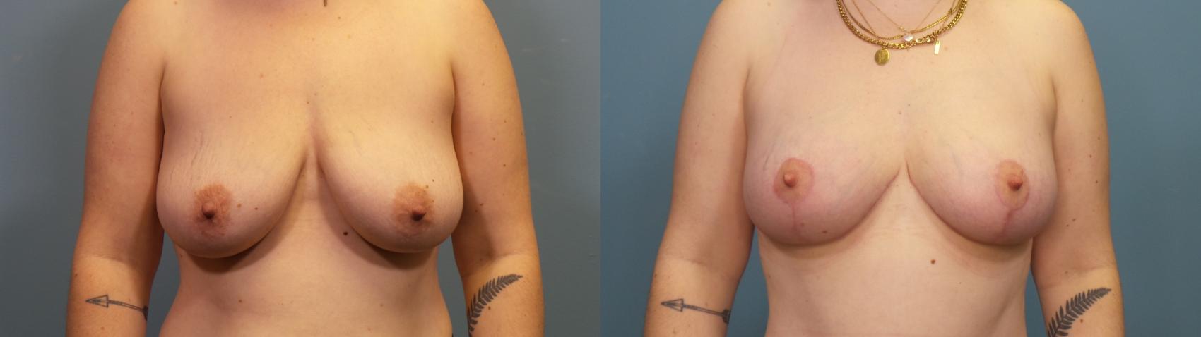 Before & After Breast Lift Case 335 Front View in Portland, OR