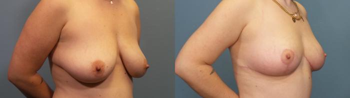 Before & After Breast Lift Case 335 Right Oblique View in Portland, OR