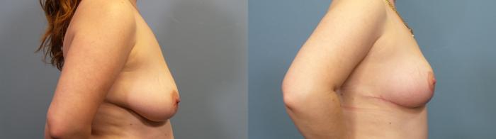 Before & After Breast Lift Case 335 Right Side View in Portland, OR