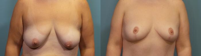 Before & After Breast Lift Case 340 Front View in Portland, OR