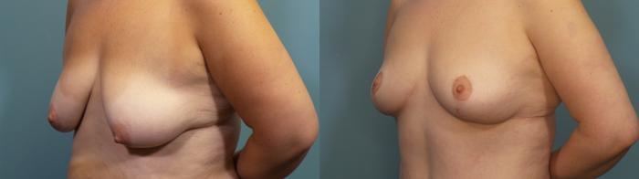 Before & After Breast Lift Case 340 Left Oblique View in Portland, OR