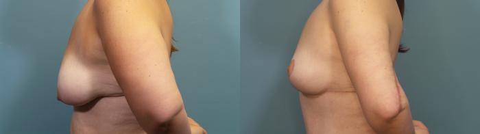 Before & After Breast Lift Case 340 Left Side View in Portland, OR