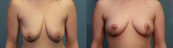 Before & After Breast Lift Case 343 Front View in Portland, OR