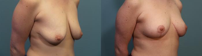 Before & After Breast Lift Case 343 Right Oblique View in Portland, OR