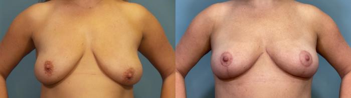 Before & After Breast Lift Case 351 Front View in Portland, OR
