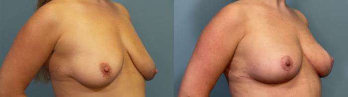 Before & After Breast Lift Case 351 Right Oblique View in Portland, OR