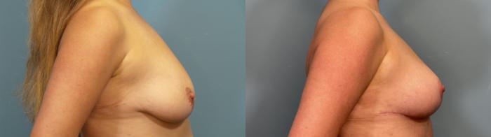 Before & After Breast Lift Case 351 Right Side View in Portland, OR