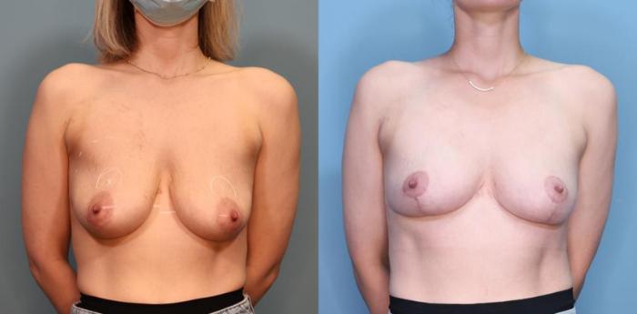 Before & After Breast Lift Case 354 Front View in Portland, OR