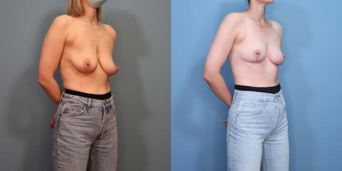 Before & After Breast Lift Case 354 Right Oblique View in Portland, OR