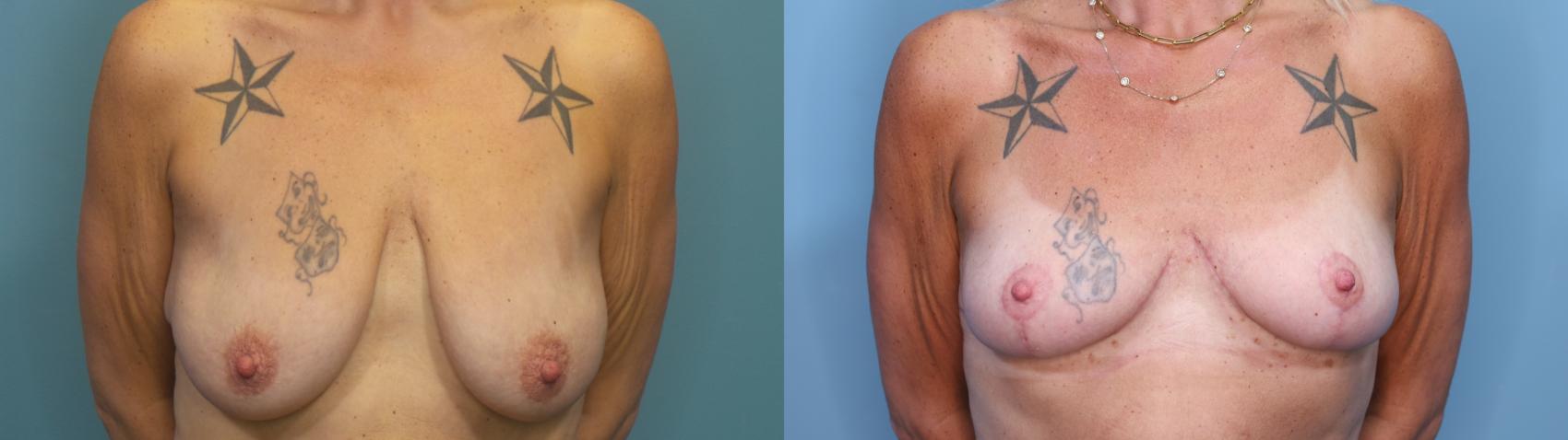 Before & After Breast Lift Case 356 Front View in Portland, OR