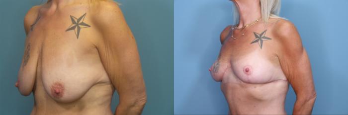 Before & After Breast Lift Case 356 Left Oblique View in Portland, OR