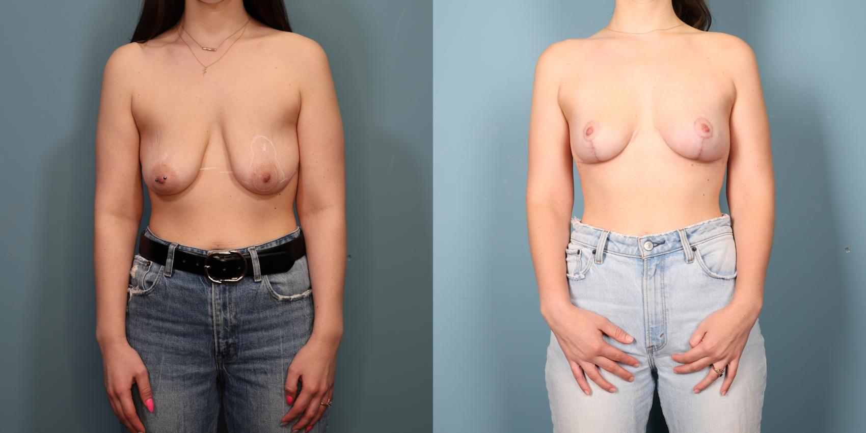 Before & After Breast Lift Case 358 Front View in Portland, OR