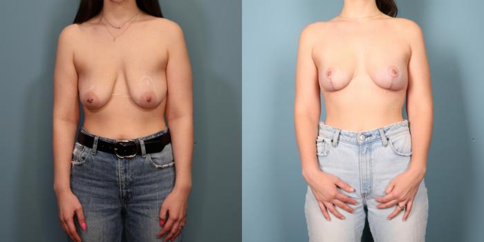 Before & After Breast Lift Case 358 Front View in Portland, OR