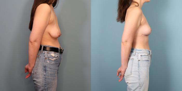 Before & After Breast Lift Case 358 Right Side View in Portland, OR