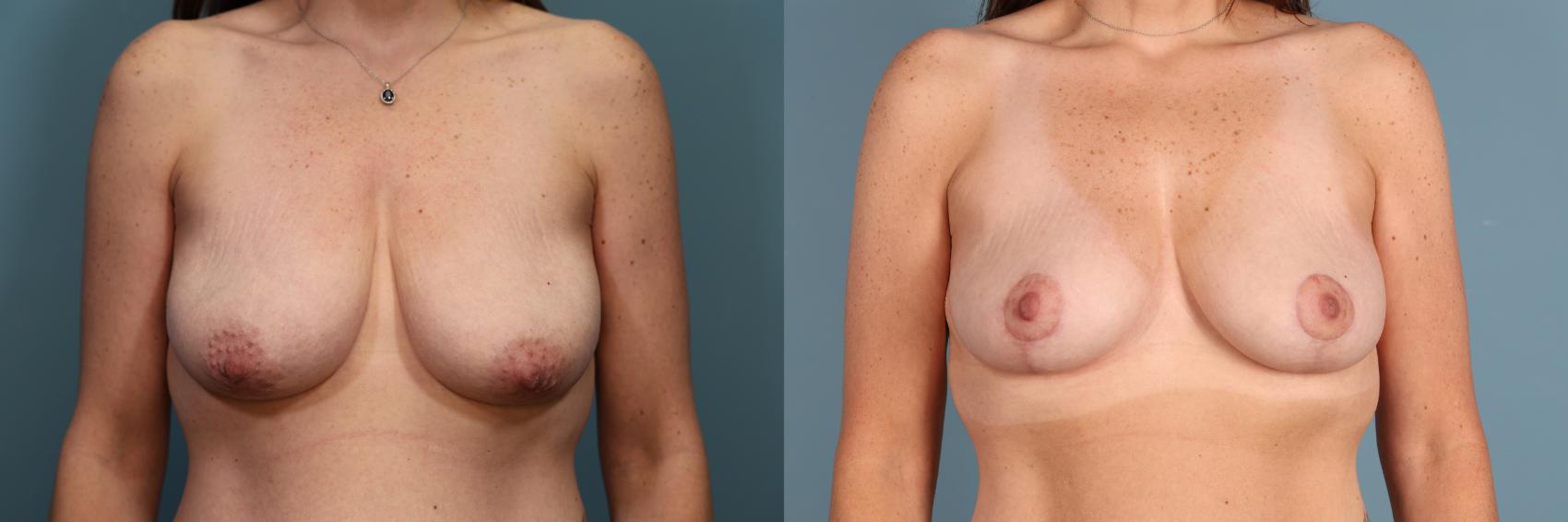 Before & After Breast Lift Case 387 Front View in Portland, OR
