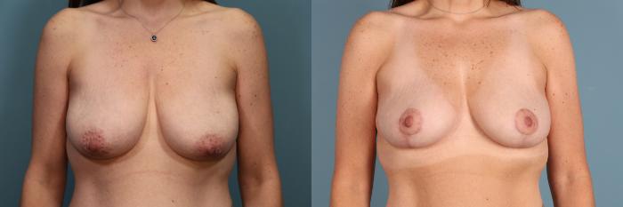 Before & After Breast Lift Case 387 Front View in Portland, OR