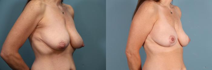 Before & After Breast Lift Case 387 Right Oblique View in Portland, OR