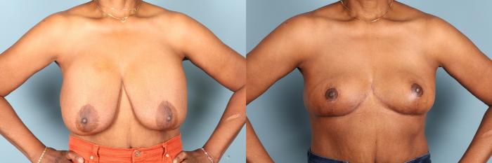 Before & After Breast Revision Case 392 Front View in Portland, OR