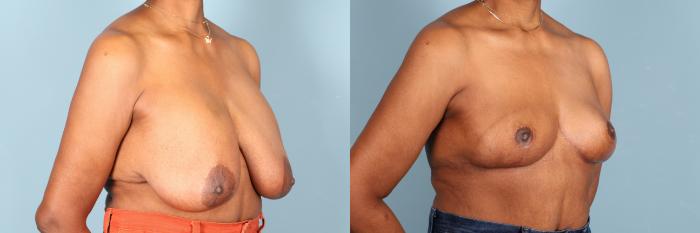 Before & After Breast Revision Case 392 Left Oblique View in Portland, OR