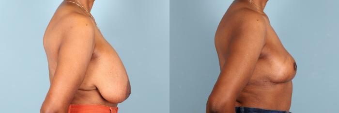 Before & After Breast Revision Case 392 Right Side View in Portland, OR
