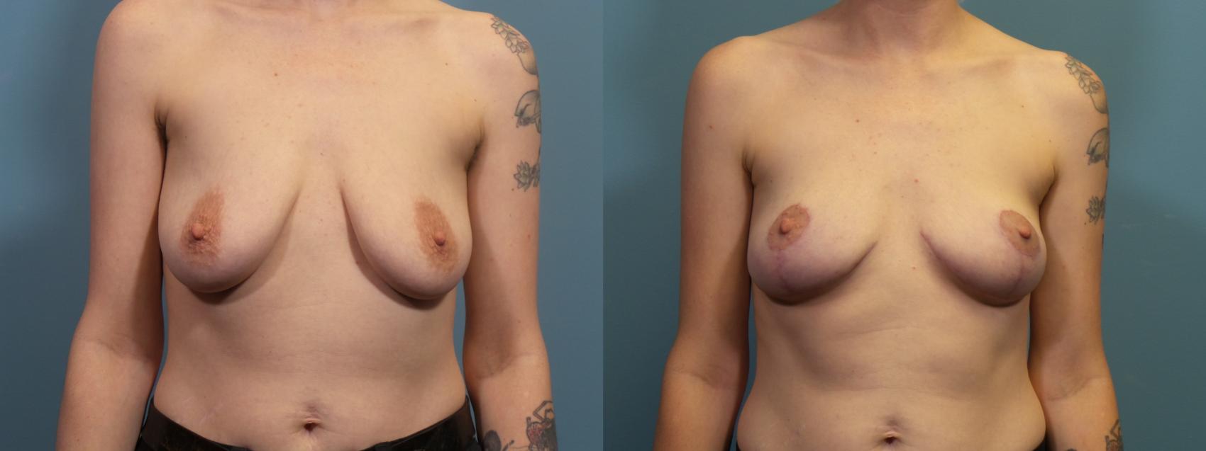 Before & After Breast Lift Case 414 Front View in Portland, OR