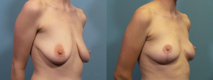 Before & After Breast Lift Case 414 Right Oblique View in Portland, OR