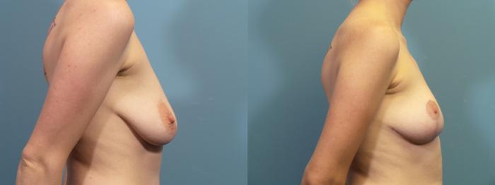 Before & After Breast Lift Case 414 Right Side View in Portland, OR