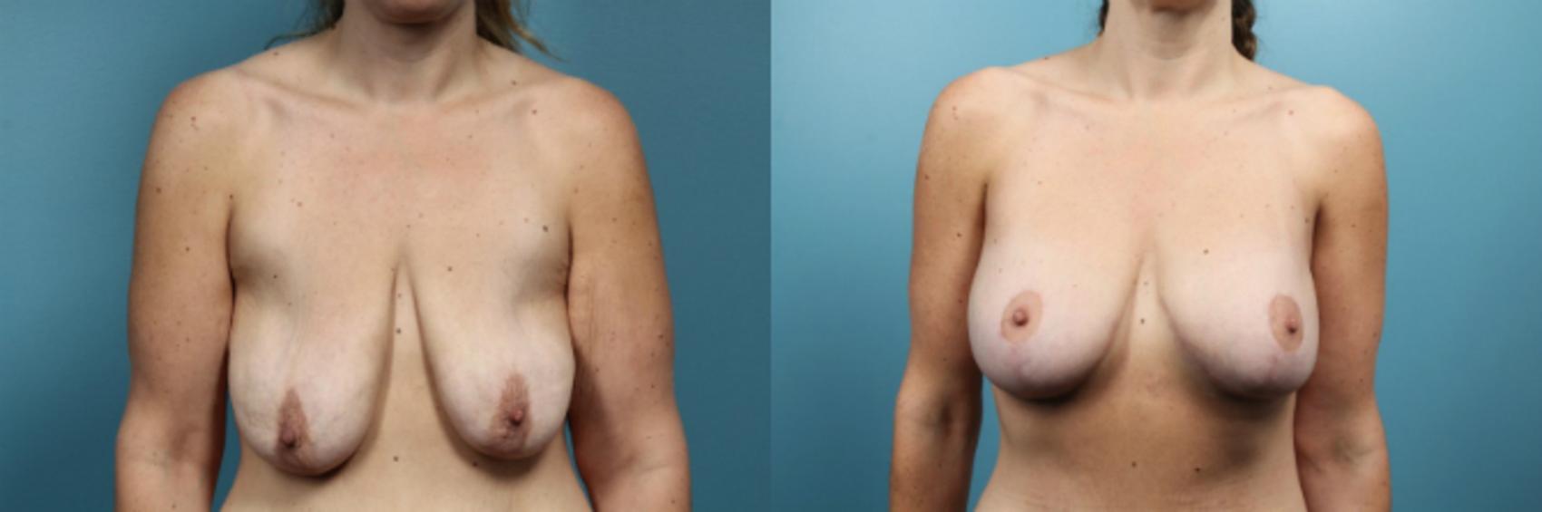 Before & After Breast Lift Case 58 View #1 View in Portland, OR