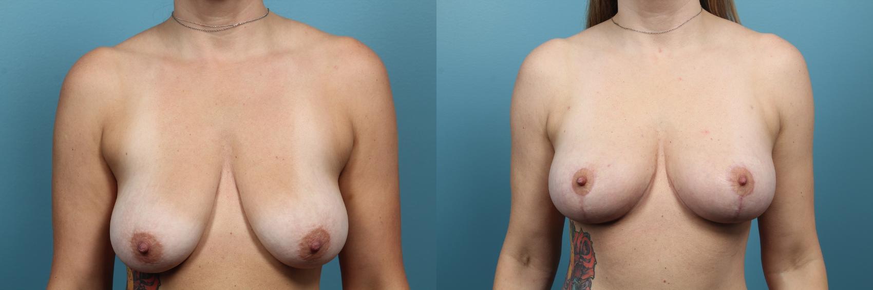 Before & After Breast Lift Case 64 View #1 View in Portland, OR