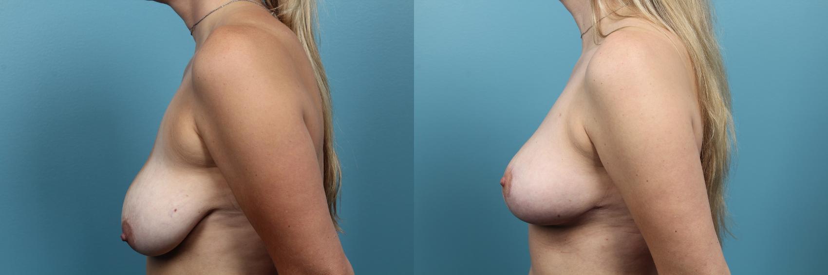 Before & After Breast Lift Case 64 View #3 View in Portland, OR