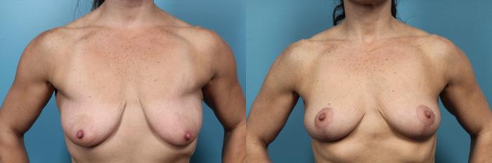 Before & After Breast Lift Case 66 View #1 View in Portland, OR